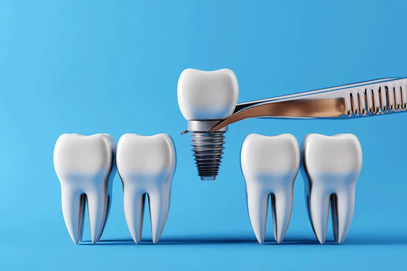 Dental Implants & Bone Grafting